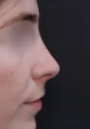 TJ Septorhinoplasty After Side