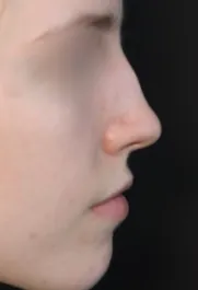 TJ Before Septorhinoplasty Profile