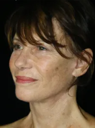 SC After Face and Neck Lift