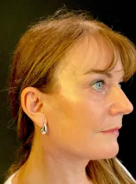 KY After Deep Plane Face and Neck Lift, Brow Lift, Bleph & Fat Transfer
