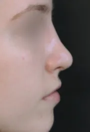TJ After Septorhinoplasty Profile