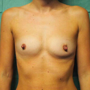 Breast Augmentation with Implants Before 1