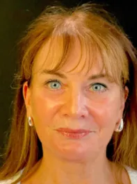 KY After Deep Plane Face and Neck Lift, Brow Lift, Bleph & Fat Transfer